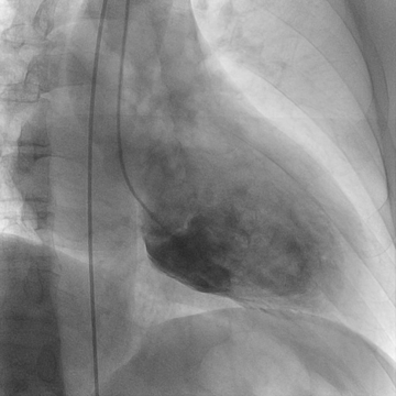 Original cine frame at 2.53 seconds showing a relatively large contrast-filled left ventricular cavity